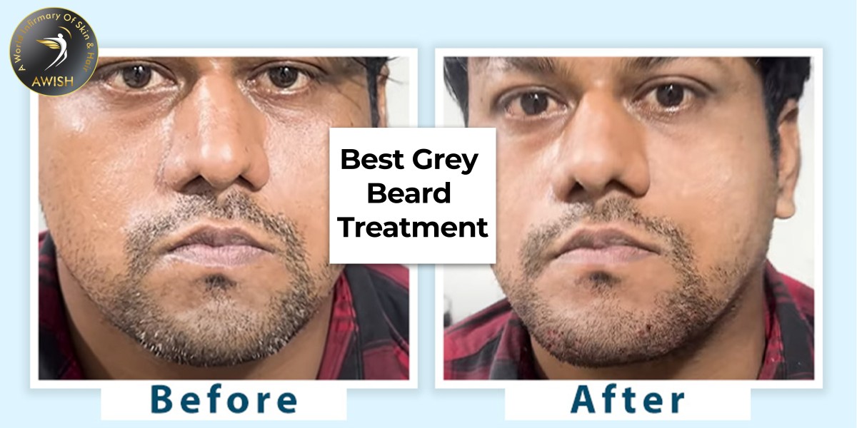 Top Dermatologists in Delhi for Permanent Grey Beard Removal